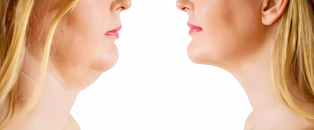 Double Chin Liposuction